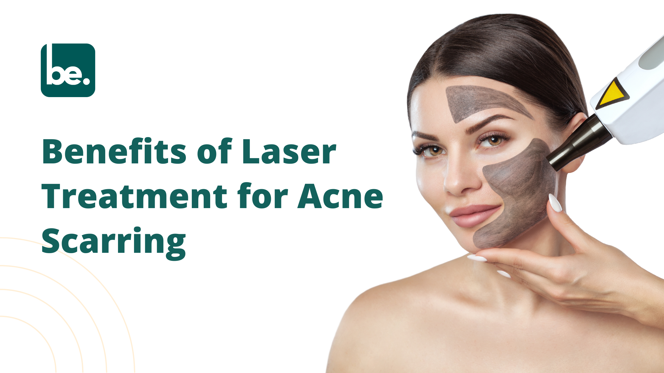 Benefits of Laser Treatment for Acne Scarring