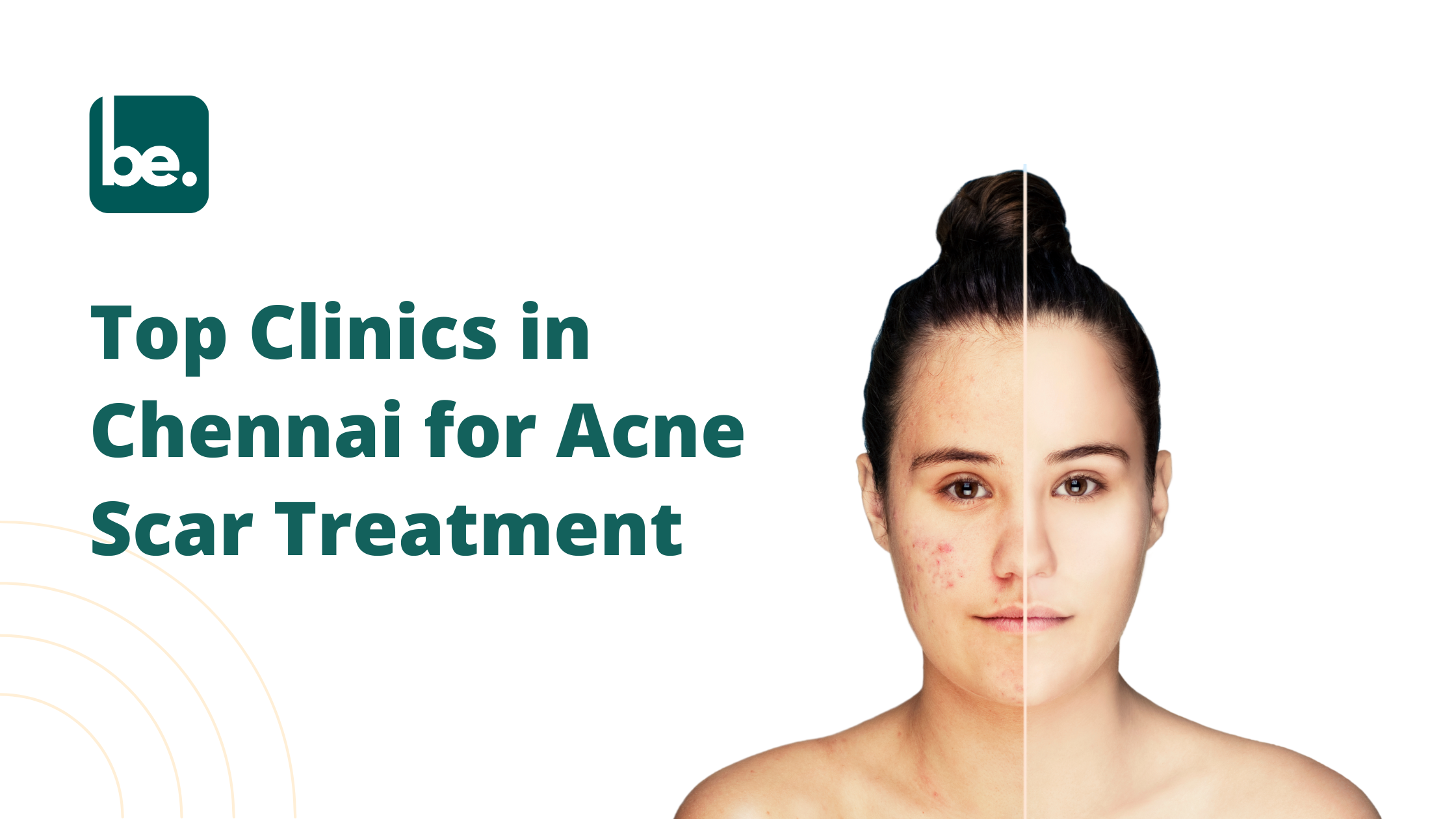 Which is the best clinic for acne scar treatment in Chennai?
