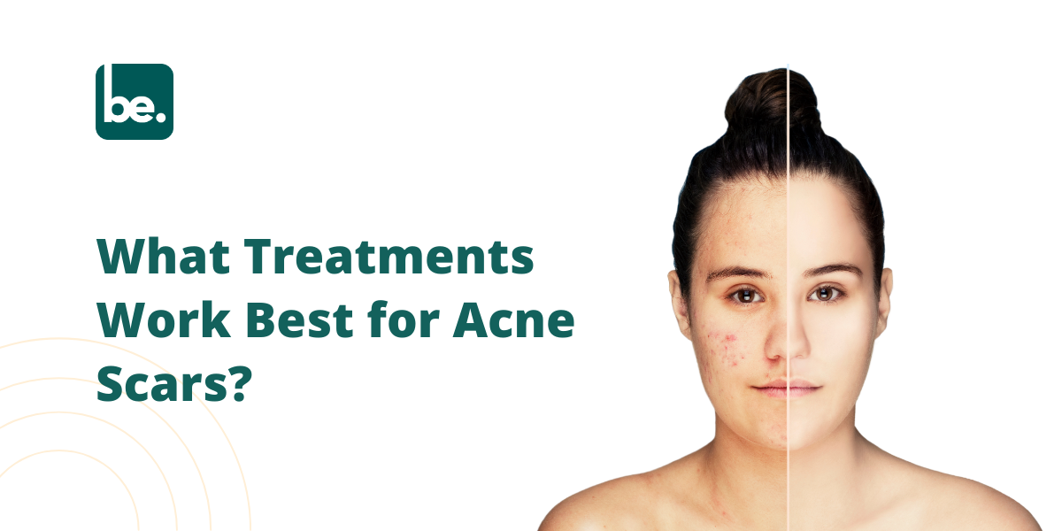 What Treatments Work Best for Acne Scars?