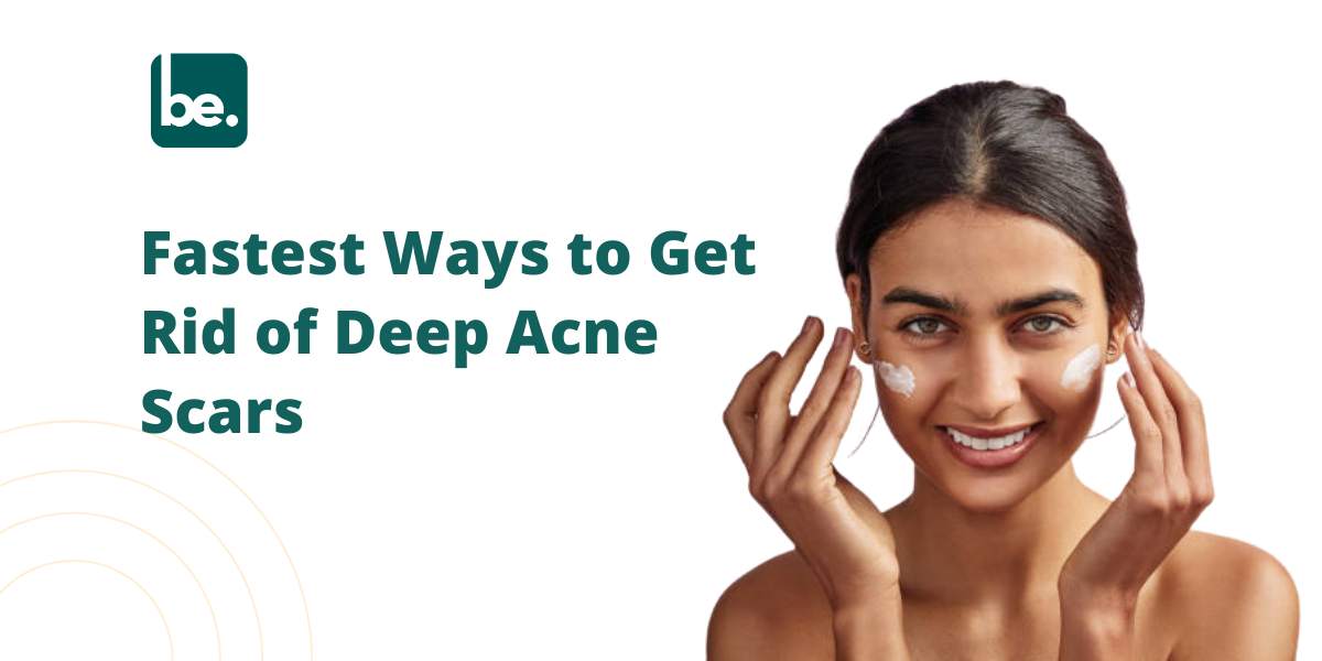 Fastest Ways to Get Rid of Deep Acne Scars