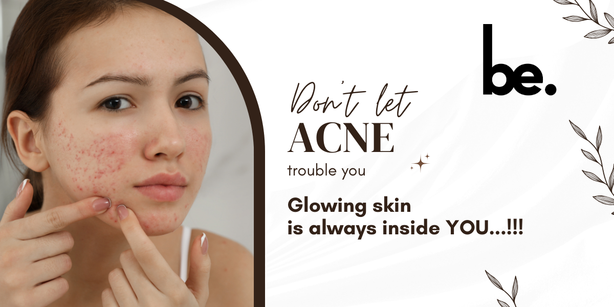 How to Choose the Best Face Wash for Acne-Prone Skin
