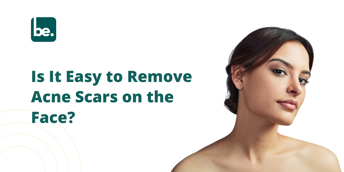 Is It Easy to Remove Acne Scars on the Face?